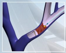 BVM Medical Baylis Powerwire | Used in Angioplasty, CTO Recanalisation, Vascular occlusion, Vascular stenting, Venous stenting  | Which Medical Device